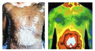 What is Thermography